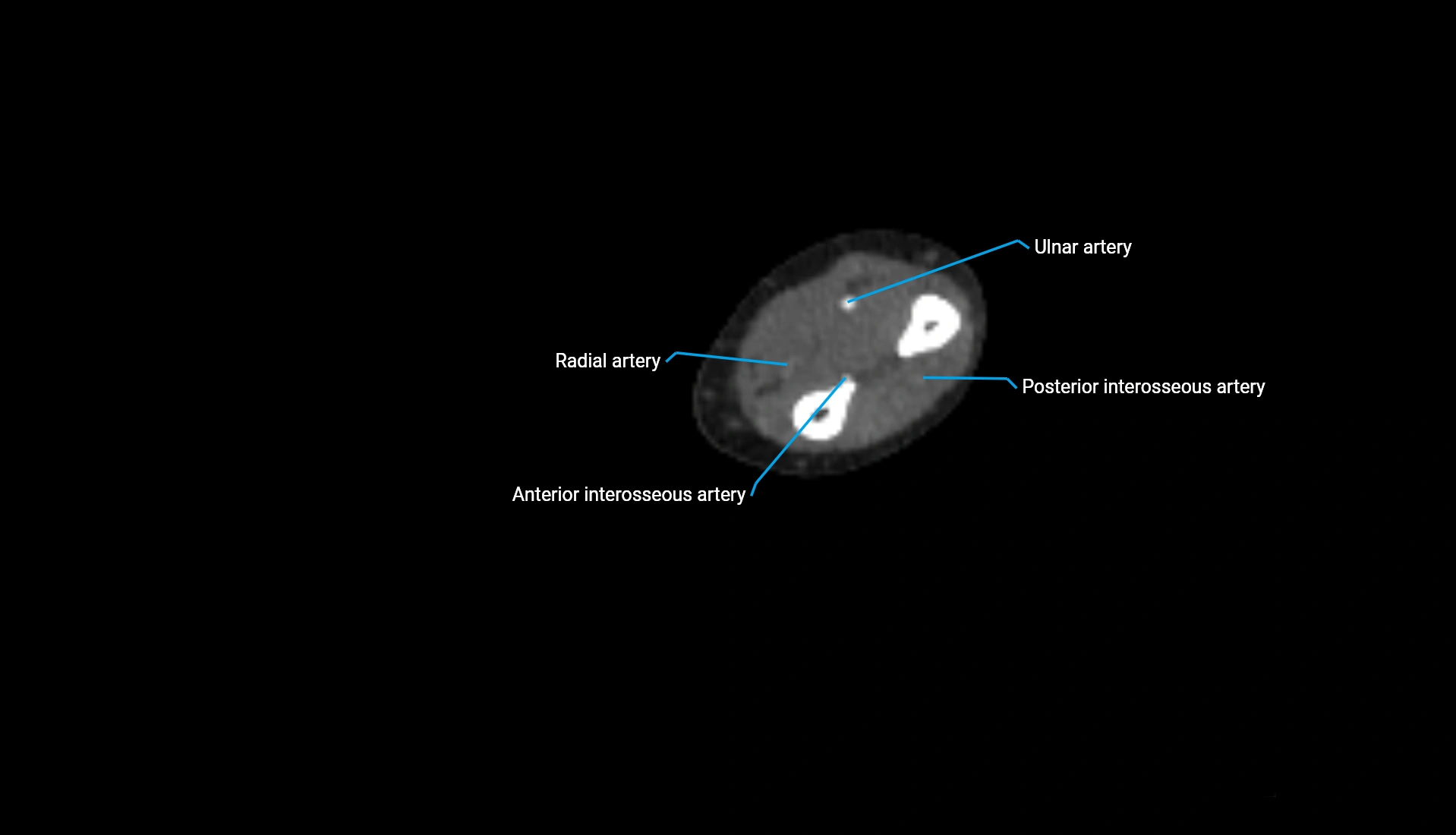 CTA upper limb axial cross sectional anatomy labelled image 138 (2).webp
